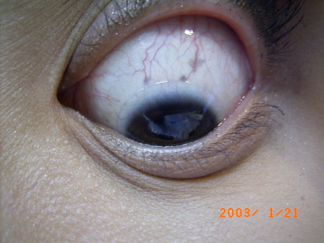 218958-眼白斑痣.jpg
