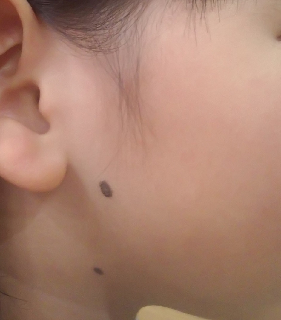 痣1.jpg