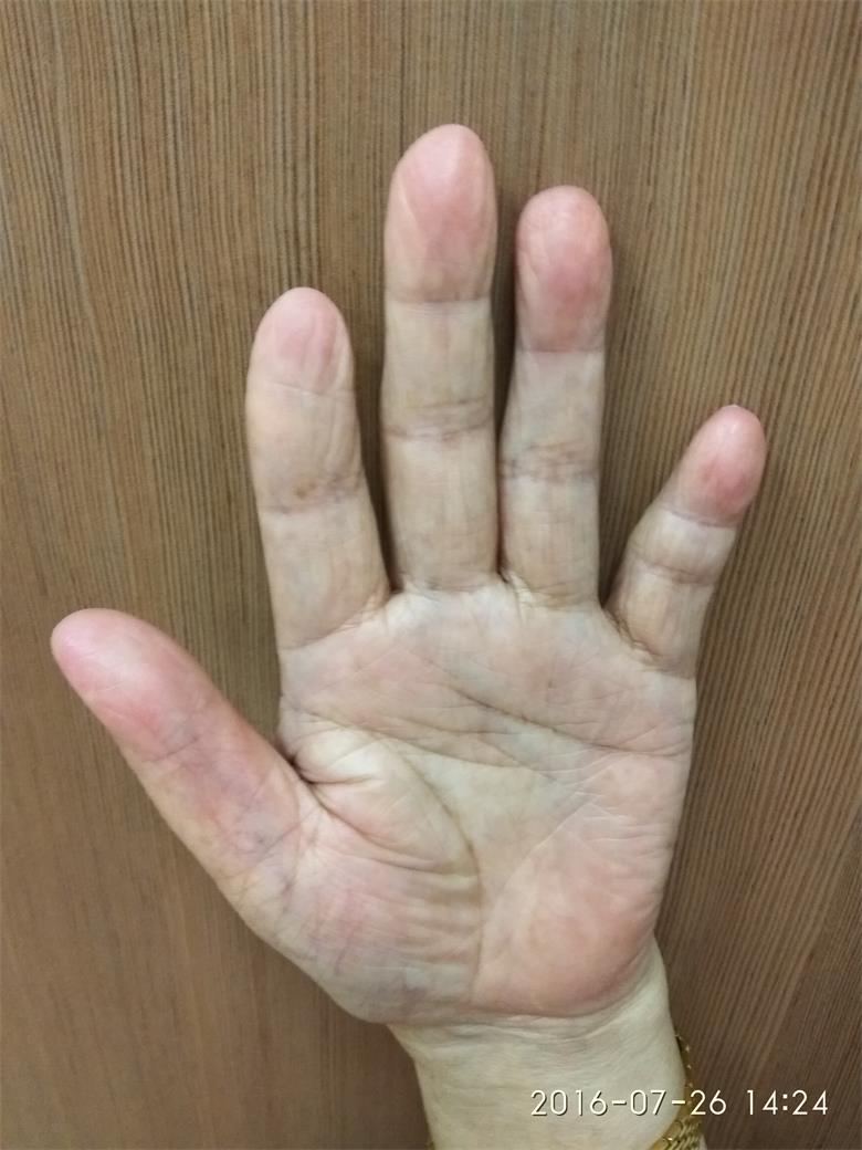 七十五歲女命左手小指歪斜死一兒子.jpg