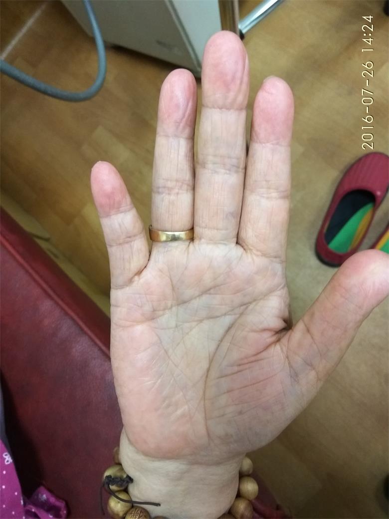 七十五歲女命右手小指歪斜死一個兒子.jpg